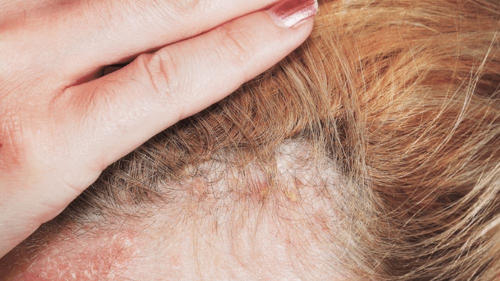 Scalp Psoriasis Vs Dandruff: Causes, Symptoms & Home Remedies